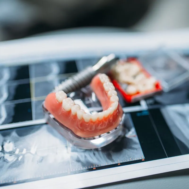 protesi dentarie specialisti dentisti a casarano